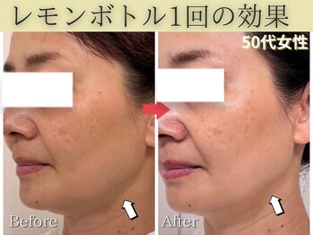 エトワール(etoile)/レモンボトル・小顔脂肪分解