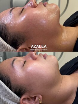 アザレア(Azalea)/マイクロウェーブリフト/恵比寿