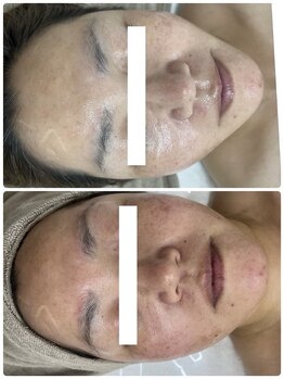 ソフィア わさだ店/30代セルマン肌質改善20回