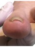巻き爪・陥入爪1か所　5500～