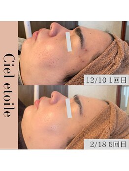 シエルエトワレ/CIVASAN シルク肌コース