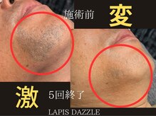 ラピスダズル(LAPIS DAZZLE)/ヒゲ脱毛☆途中経過