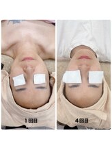 ナニワ ビューティー(naniwa beauty)/光フェイシャル