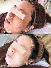 ビアンカ/ニキビケア/あとケア