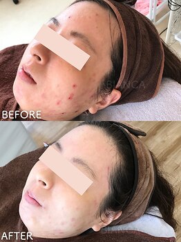 ビアンカ/ニキビケア/あとケア