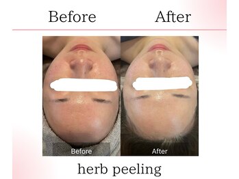 サロンツキ(salon tuki)/ハーブピーリング症例/徳島