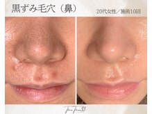 スリースリー 恵比寿(THREE THREE)/毛穴角栓・毛穴黒ずみ・毛穴開き
