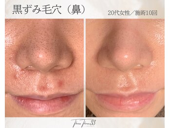 スリースリー 恵比寿(THREE THREE)/毛穴角栓・毛穴黒ずみ・毛穴開き