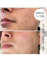 ココスターリー 香椎店(Coco starry)/男性・照射3回☆1ヶ月後