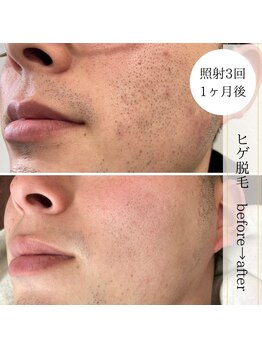 ココスターリー 香椎店(Coco starry)/男性・照射3回☆1ヶ月後