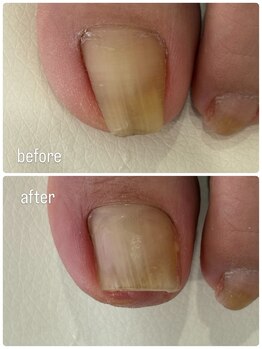 リーブル(Libre)の写真/角質ケアはもちろん、巻き爪などのお悩みも対応可能!トラブルフットケアマスター在籍サロン◎