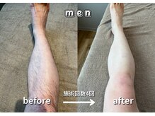 キュー(cue)/【メンズ】「脚脱毛」施術事例