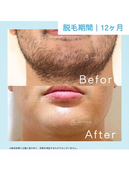 メンズクリア 高崎店/【メンズクリア】お客様の施術例