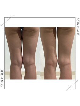 スキンホリック 恵比寿駅前店(SKIN HOLIC)/下半身☆痩身ビフォア＆アフター