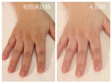 キレイテ 福岡天神店/むくみと関節の黒ずみ