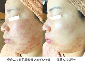 アンシャンテ 芦屋店/繰り返すニキビケア・黒ずみに