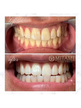 ミタメ 銀座店(MITAME)/劇的変化のセルフホワイトニング