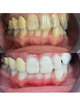 エクシアホワイトニング 新小岩店/ホワイトニングビフォーアフター