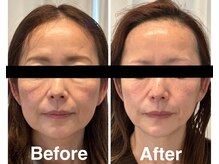 ラキネイ 目黒(Lakinei)/テラボーラー＆ハイドロセット☆