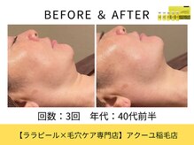 ア クーユ 稲毛店/レモンボトル/二重あご/小顔