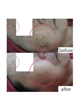 アップルミント/＜フェイシャル＞before・after