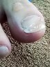 巻き爪補正【軽度】　5500円→4800円　◎カウンセリング15分込み