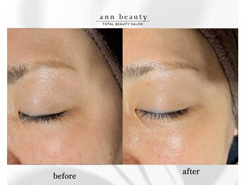アン ビューティー(ann beauty)/施術1回【症例写真】