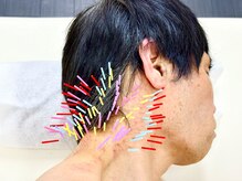 とだ鍼灸院/《鍼灸施術》首肩レスキュー鍼灸