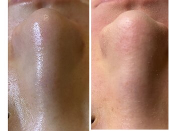 ユフラ(Juhla)/韓国式3D毛穴洗浄/毛穴汚れOFF