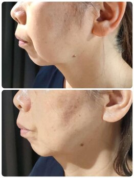 ラピスラズリ/水光レモンボトル結果【6回】