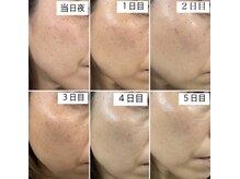 ノート(NOTE)/しみケア20分＋美容液導入