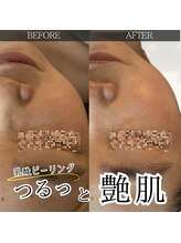 オルオル(.olu olu)/乳酸ピーリングモニター様