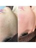 【顔脱毛】美肌への第一歩！艶肌WAX脱毛+光脱毛¥9900→¥8800