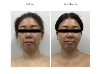 ルミエール(Rumiere)/ウィンバックフェイシャル施術