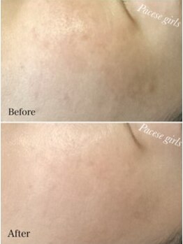 パーチェスガールズ 姪浜店(Pace-se Girls)/シミケア