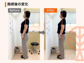 ただき接骨院 整体院 高関院/施術後の変化：反り腰