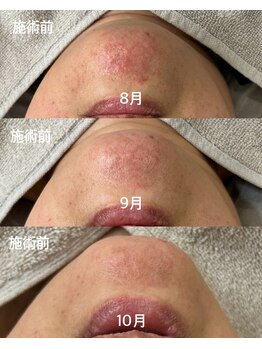 ベリンダ ワックス(BELINDA WAX)/お肌の改善♪