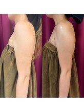 【ハーブピーリング/毛穴洗浄/小顔リフト】total beauty salon mayahime 大宮店/二の腕のオンダリフト