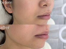 アイブロウドット 川越店(iBROW.)/大人気パーツ脱毛！