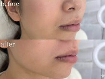 アイブロウドット 川越店(iBROW.)/大人気パーツ脱毛！