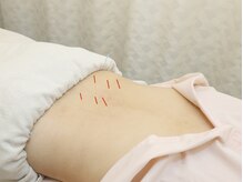 丸太町骨盤整骨院 鍼灸院/産後の肩こり鍼灸