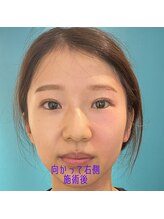 ネクスフィット(Nexfit)/小顔矯正フェイスリフトの効果