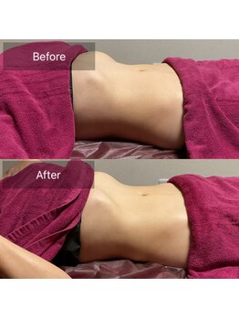 ミースリーズ(methrees)/1回でお腹えぐれた!【腸もみ】