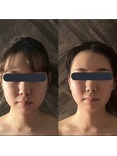 ハイコガオ 中崎町店(HIKOGAO)/小顔矯正