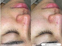 フォンビューティー(fon beauty)/肌質改善1回