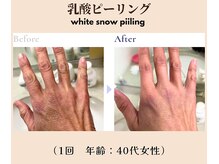 アフロディーテ(Aphrodite)/◆乳酸ピーリング◆