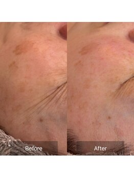 リノアドット(LiNOA.)の写真/施術後に「毛穴がキュッと引き締まった」「肌がもちもちして明るくなった」と思える結果に導きます！