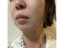 ハーバリー ハーブピーリング 岐阜(HERBERRYハーブピーリング)/ハーブピーリング専門店HERBERRY