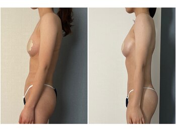 モア(moa)/全身バスト　初回と7回目の比較