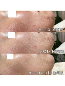 ニュアージュ(Nuage)/30代女性 ニキビケアの変化